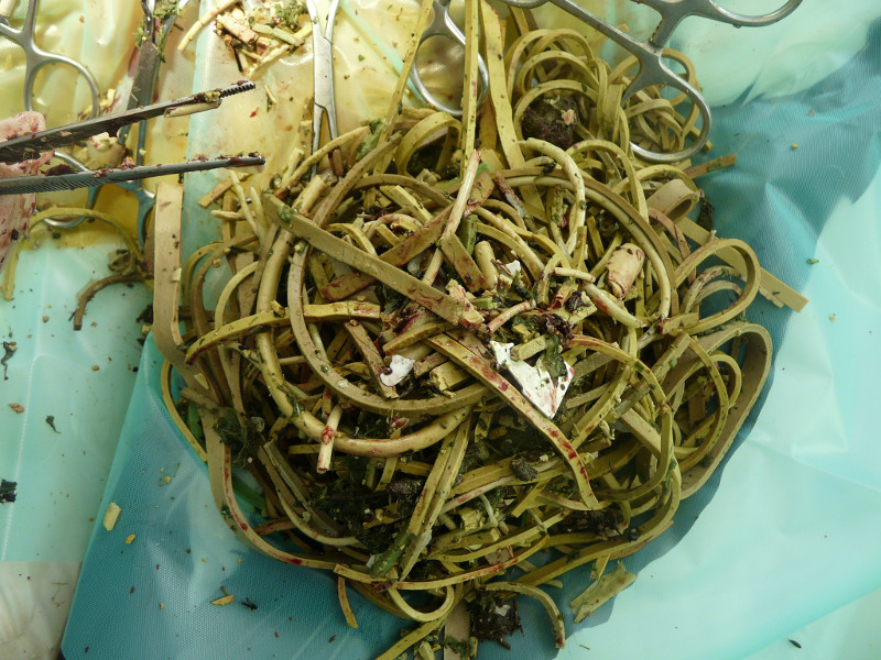 Gomas extraidas en quirófano