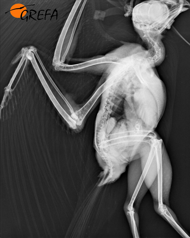 Foto que muestra la mala osificación de una luxación de codo